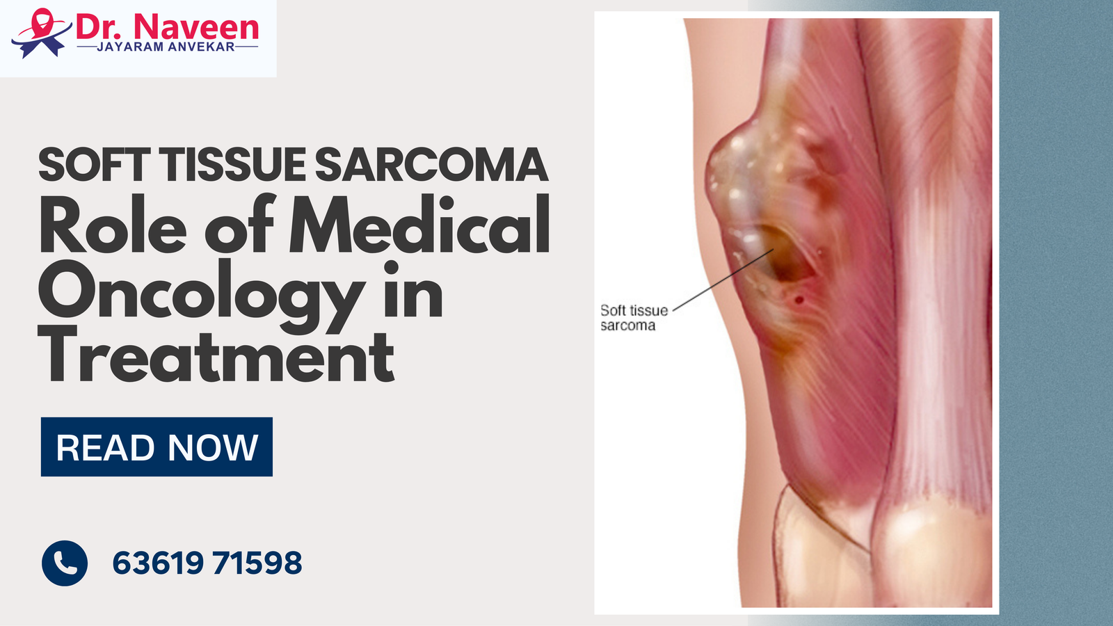 Soft Tissue Sarcoma